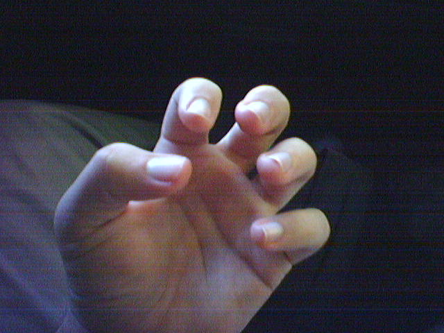 crippled hands from popping plastic